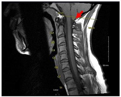 Case Report: Syphilitic Hepatitis–A Rare and Underrecognized Etiology of Liver Disease With Potential for Misdiagnosis